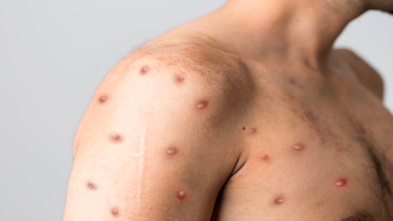 Monkeypox: देश में मंकीपॉक्स ने दी दस्तक, केजरीवाल सरकार हुई सतर्क, एलएनजेपी अस्पताल को बनाया नोडल केंद्र