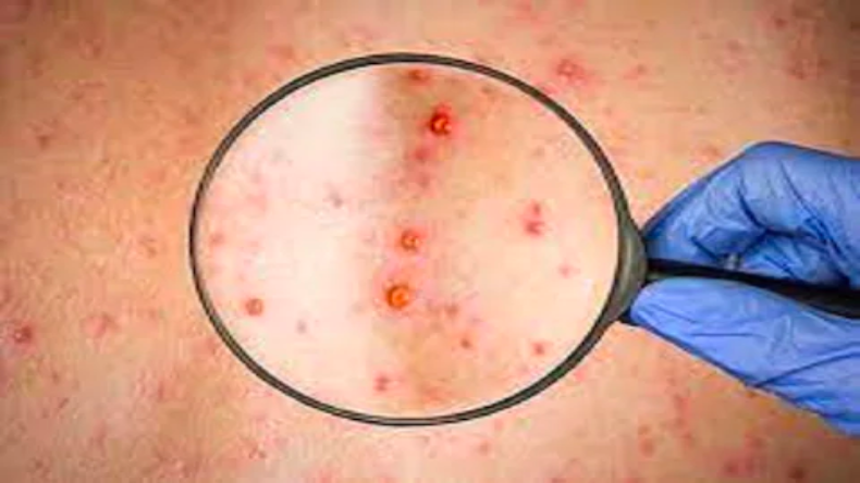 Monkeypox: सीरम इंस्टीट्यूट के अदार पूनावाला का मंकीपॉक्स वैक्सीन को लेकर क्या है प्लान? खुद दी ये जानकारी