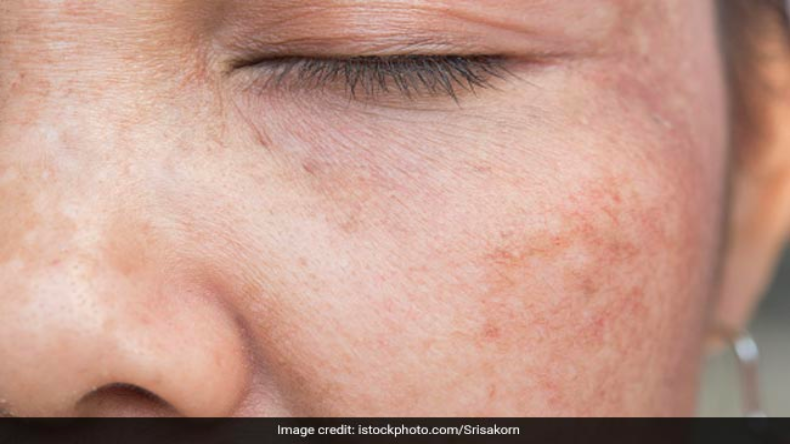 गर्मियों में इस तरह लगाएं मुल्तानी, जानें 5 तरीके, जिनसे मिलेगी मुलायम और चमकदार त्वचा