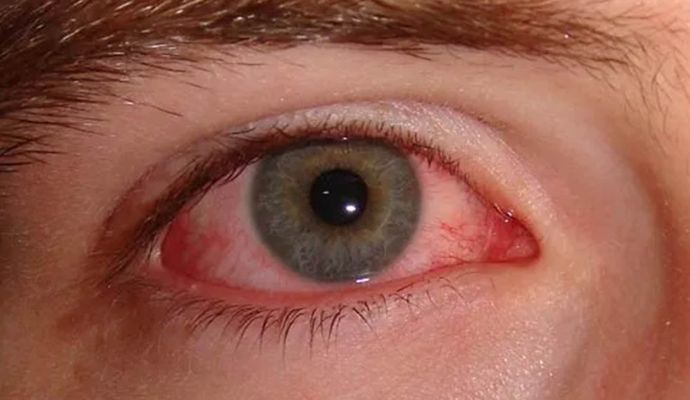 Eye Flu: अस्पतालों में तेजी से बढ़ रहे आई फ्लू के मामले, जानें क्या हैं लक्षण और बचाव