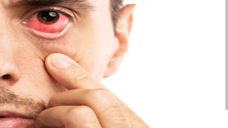 Conjunctivitis: क्या संक्रमित व्यक्ति को देख फैलता है आई फ्लू? जानें डॉक्टर्स की सलाह