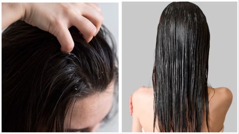 Hair Care: पाना चाहते है ऑयली बालों से छुटकारा,तो ये टिप्स सिर्फ आपके लिए