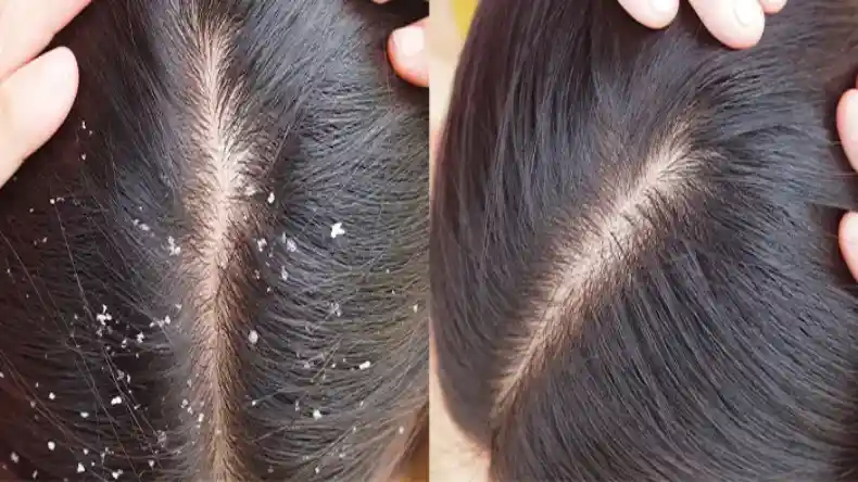 दोमुंहे बालों से परेशान? अभी अपनाएं ये घरेलू नुस्खे, 10 रुपए मिलेगा में छुटकारा