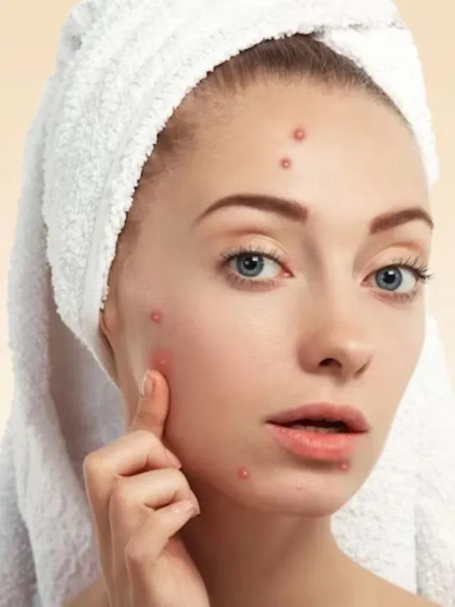 चेहरे पर मुंहासे भी देते हैं खतरनाक बीमारियों का संकेत!