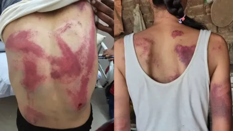 मंदिर के लाउडस्पीकर पर आपत्ति जताना वकील को पड़ा महंगा, भीड़ ने की बेरहमी से पिटाई, पीठ हुआ लाल-सुर्ख